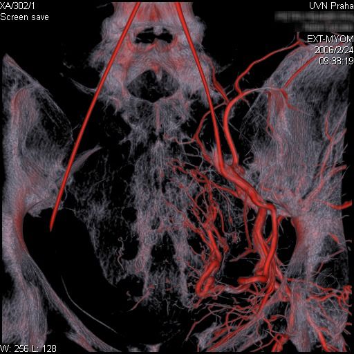 Obr. 2.8. Zobrazení větvení cév v malé pánvi u pacientky s objemnou myomatózou (magnetická rezonance v kombinaci s angiografií) Obr. 2.8. Zobrazení větvení cév v malé pánvi u pacientky s objemnou myomatózou (magnetická rezonance v kombinaci s angiografií)